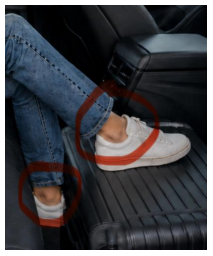 Bruises appeared on both ankles of an AI-generated image